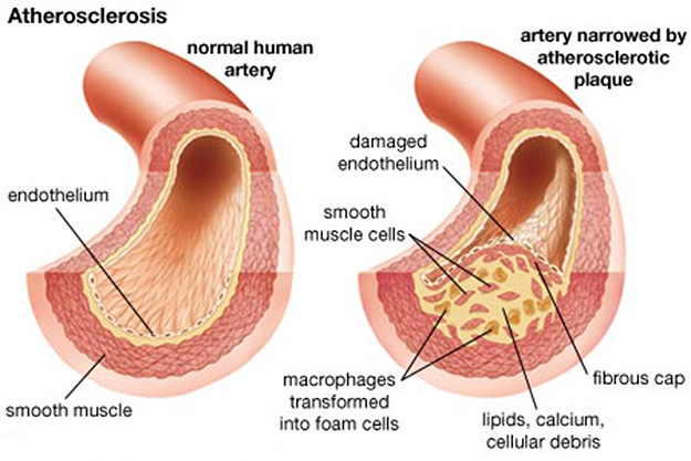Atherosclerosis-Diagram